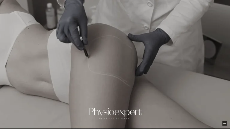 EXILIS v1 - Celulit Ekspert - Lider u estetskoj i fizikalnoj terapiji