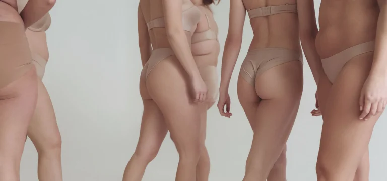 CELULIT II–III STEPENA 4 vrste celulita celulit