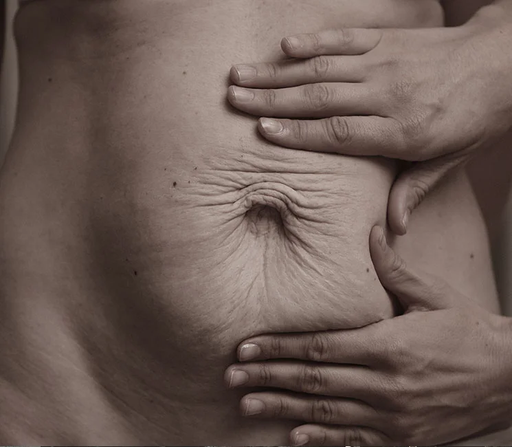 Dijastaza stomaka i salo na stomaku